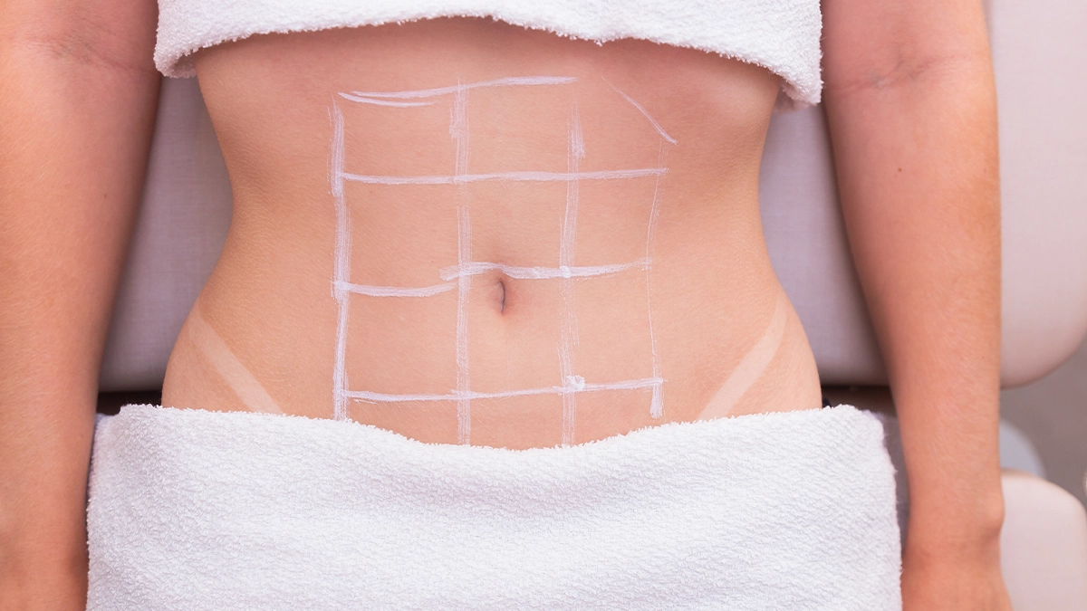 آمبولی بعد از جراحی ابدومینوپلاستی