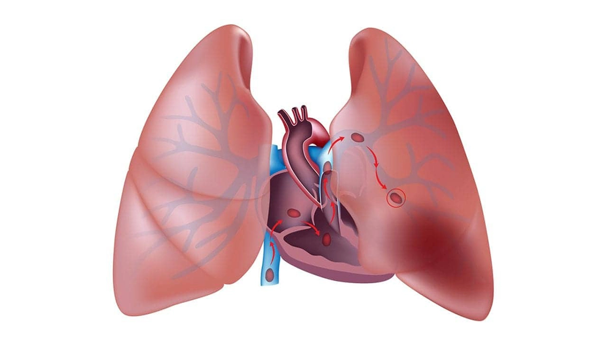 دلایل بروز آمبولی بعد از ابدامینوپلاستی