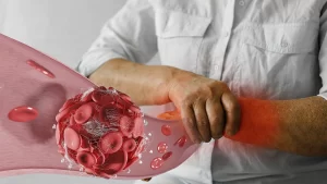 آمبولی بعد از جراحی