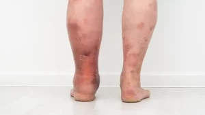 لخته شدن خون بعد از جراحی تعویض مفصل زانو