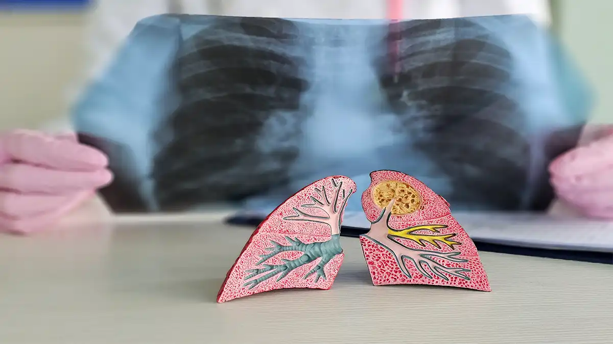 علائم اولیه آمبولی بعد از عمل دیسک کمر