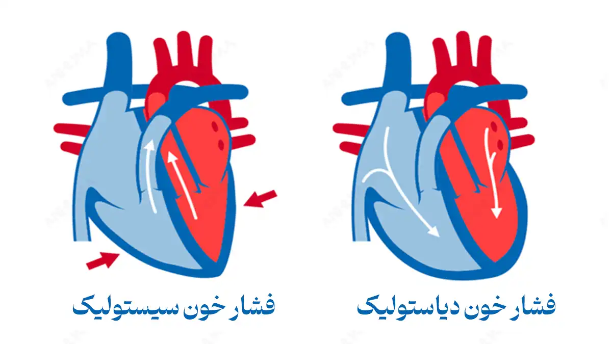 فشار خون سیستولی و دیاستولی بالا