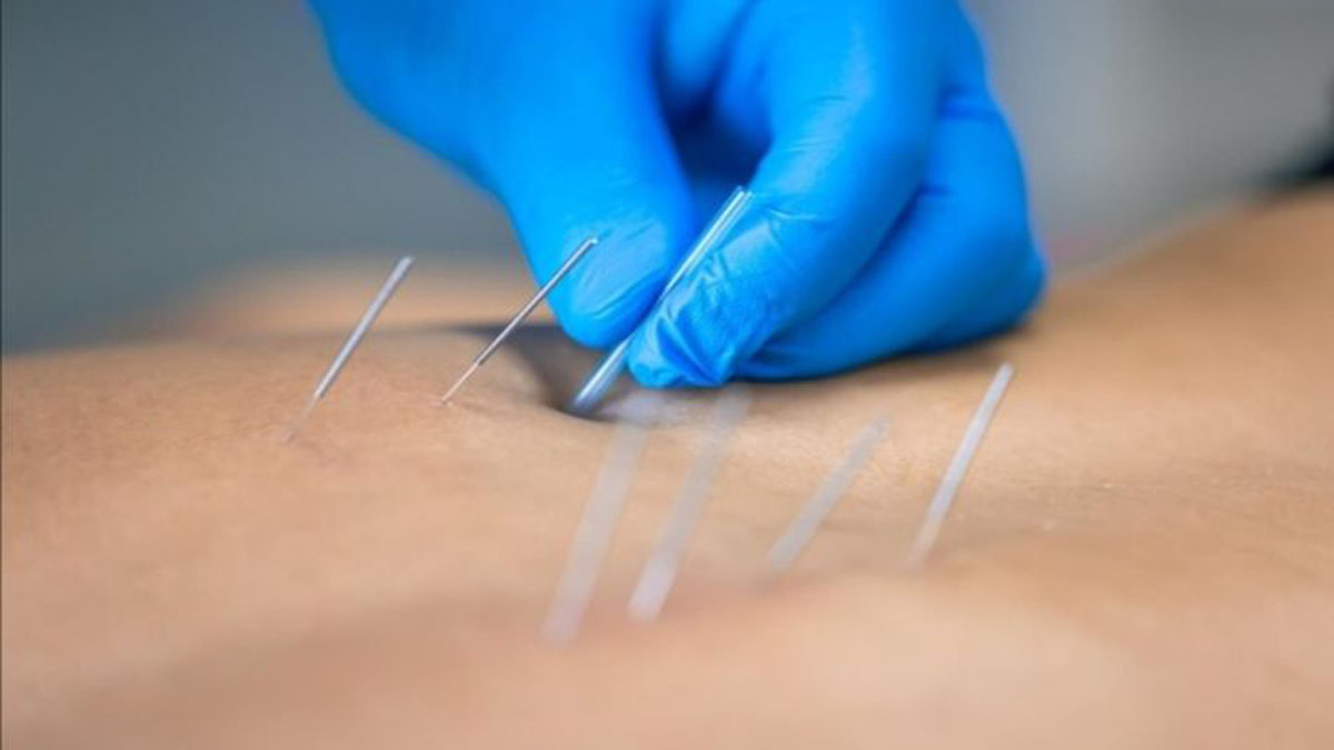 طب سوزنی در کنار توانبخشی