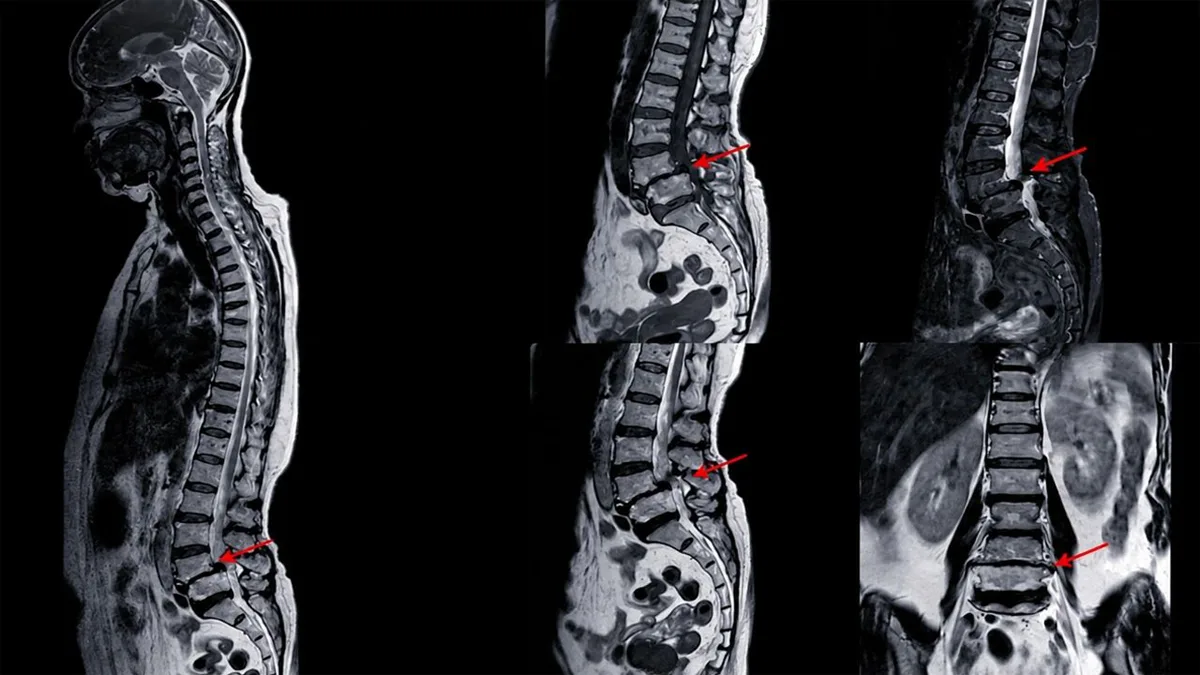 ضایعه نخاعی کمری (Lumbar Injury)