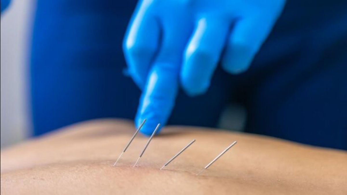 اصول طب سوزنی ضایعه نخاعی