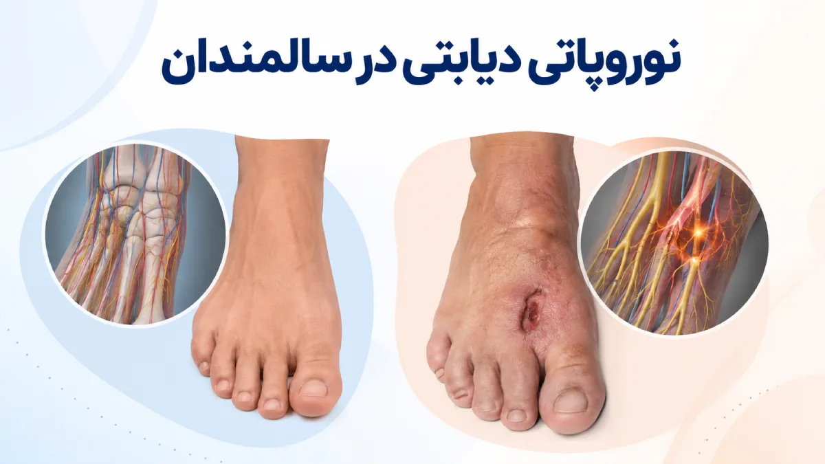 نوروپاتی دیابتی در سالمندان+علائم ، تشخیص،عوارض