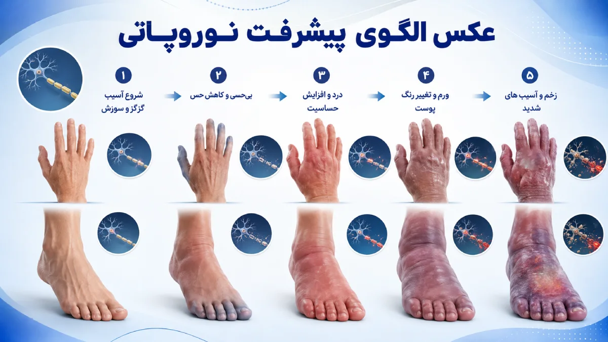 عکس الگوی پیشرفت نوروپاتی