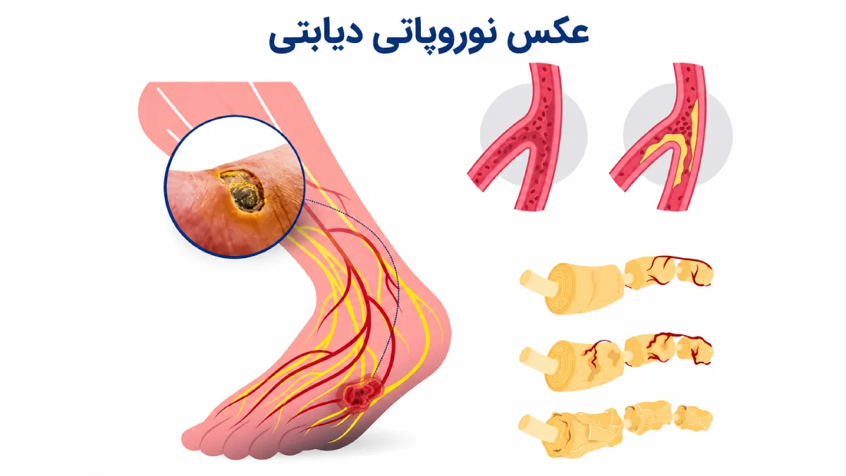 عکس نوروپاتی دیابتی