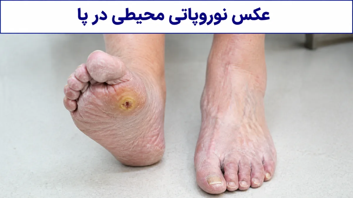 عکس نوروپاتی محیطی در پا