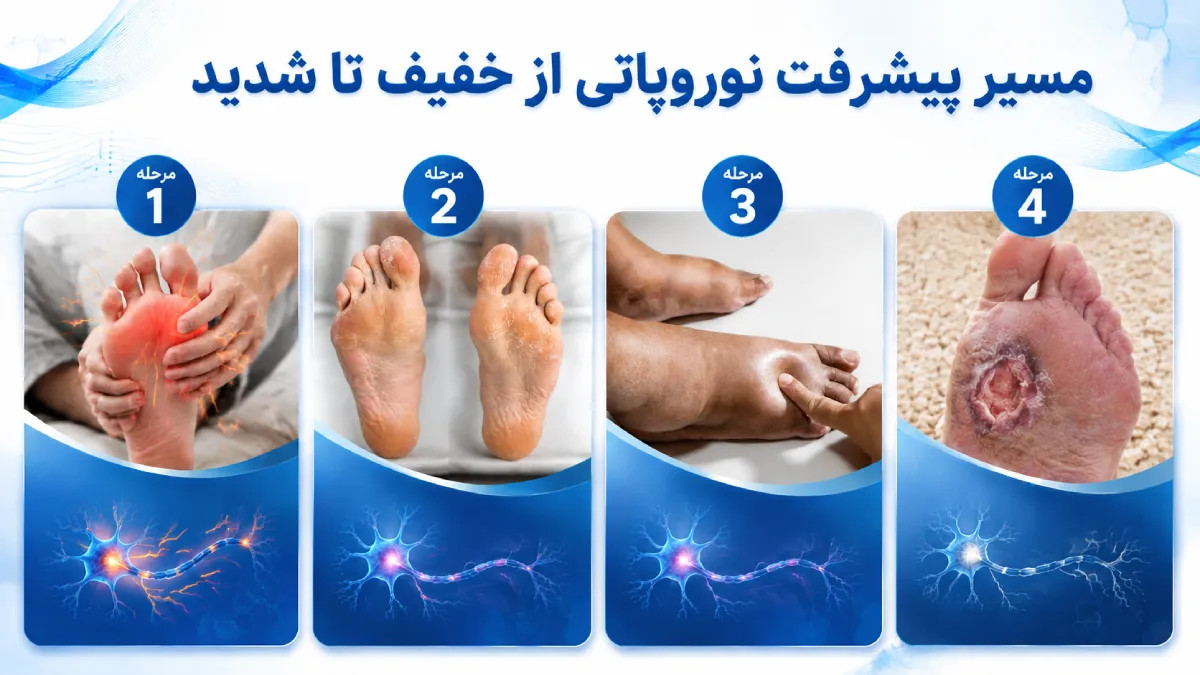 عکس مراحل نوروپاتی ازخفیف تا شدید