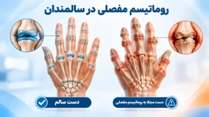 روماتیسم مفصلی در سالمندان+ علائم ،عوارض، تشخیص