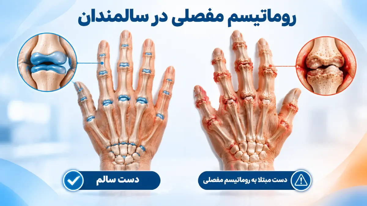 روماتیسم مفصلی در سالمندان+ علائم ،عوارض، تشخیص