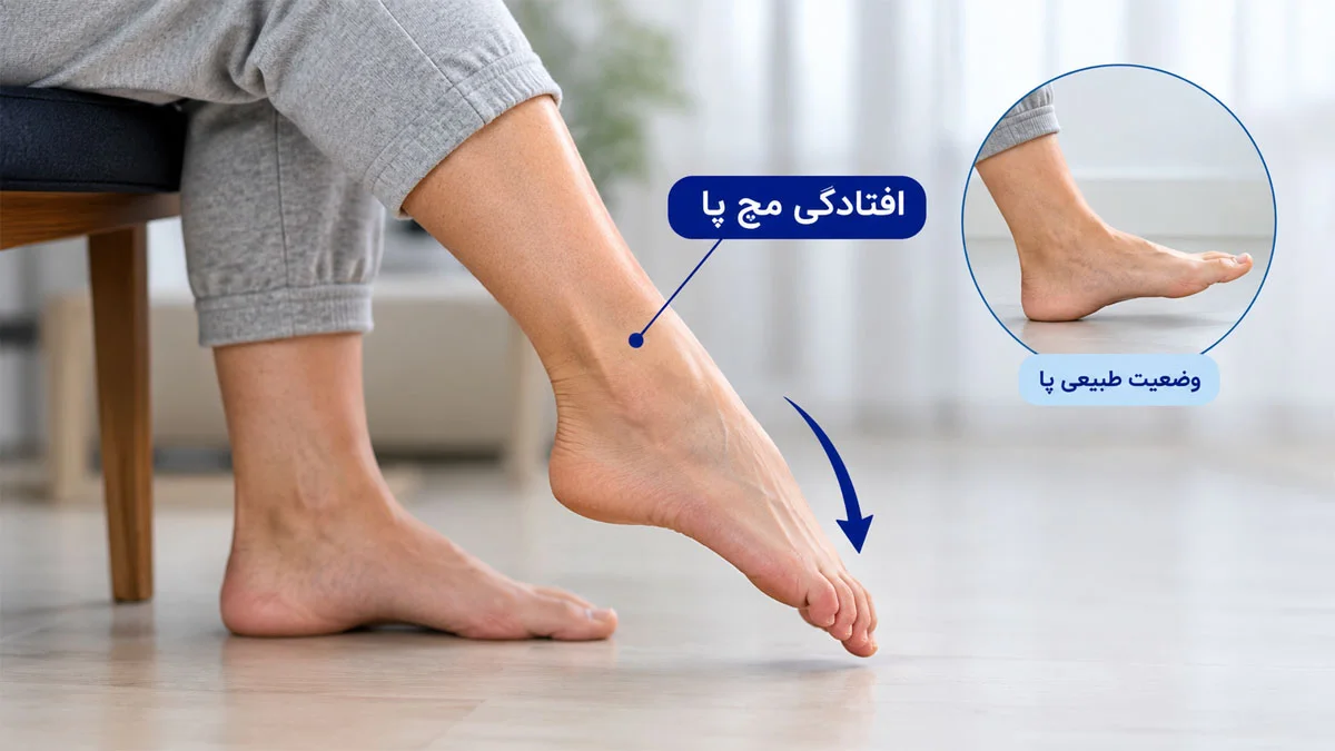 افتادگی مچ پا